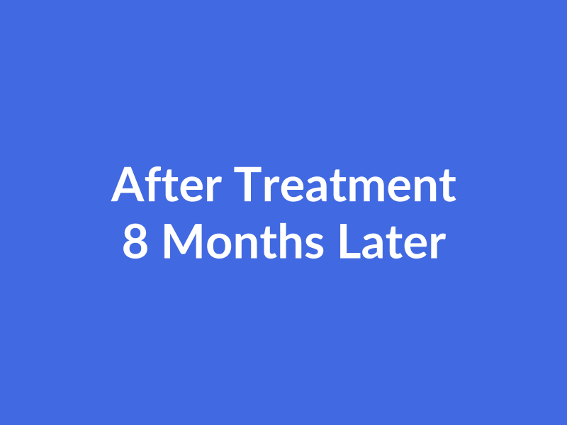 PRP Therapy Results - After