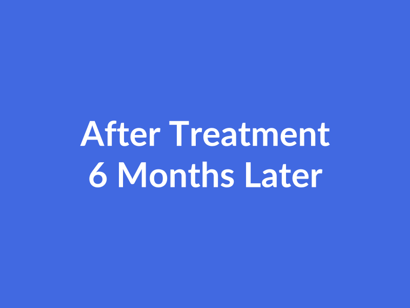 Advanced Hair Transplant - After