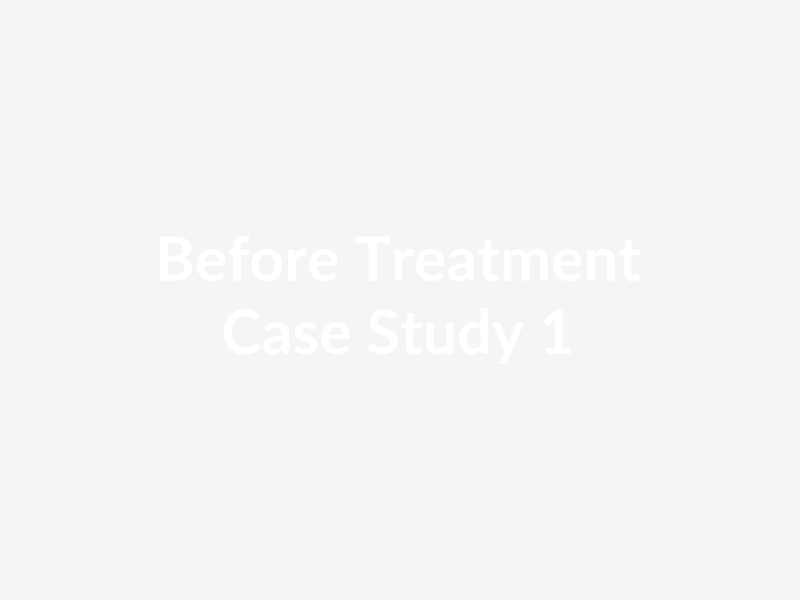 Hair Transplant - Before & After - Before